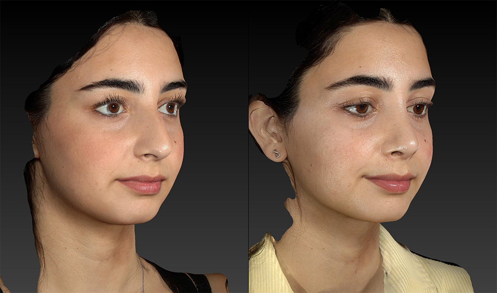 before and after rhinoplasty right angle view female patient case 3643