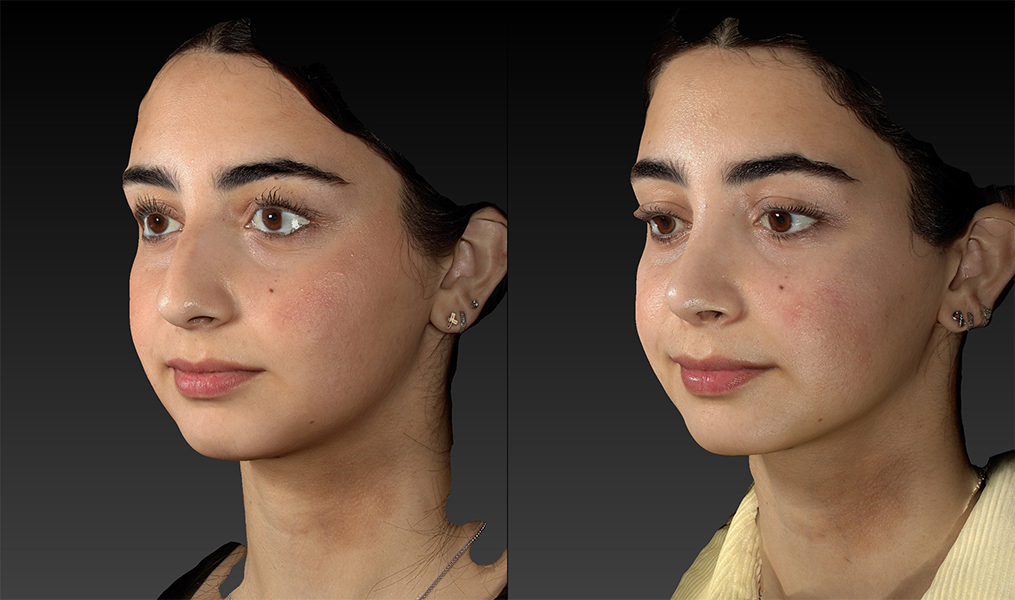 before and after rhinoplasty left angle view female patient case 3643