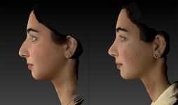 before and after rhinoplasty left side view female patient case 3643