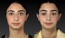 before and after rhinoplasty front view female patient case 3643