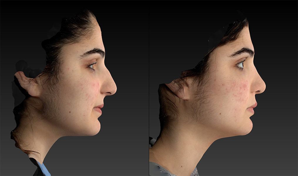before and after rhinoplasty right side female patient case 3650