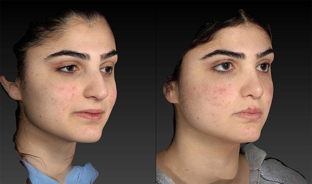 before and after rhinoplasty right angle view female patient case 3650