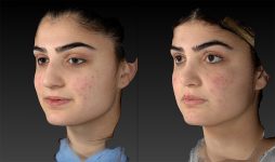 before and after rhinoplasty left angle view female patient case 3650
