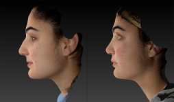 before and after rhinoplasty left side view female patient case 3650