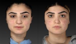 before and after rhinoplasty front view female patient case 3650