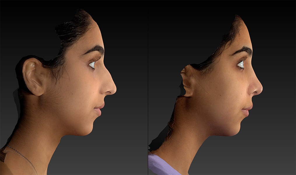 before and after rhinoplasty right side female patient view case 3657
