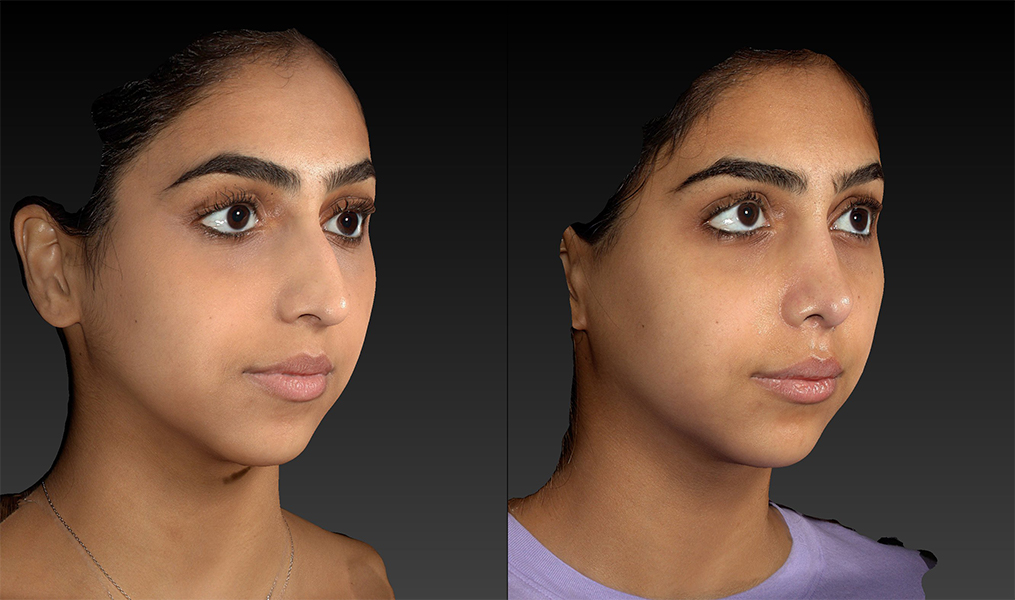before and after rhinoplasty right angle female patient view case 3657