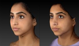before and after rhinoplasty left angle female patient view case 3657