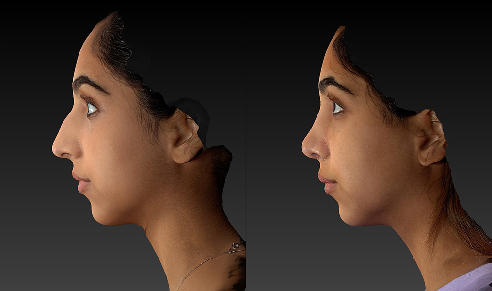 before and after rhinoplasty left side female patient view case 3657