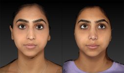 before and after rhinoplasty front view female patient case 3657