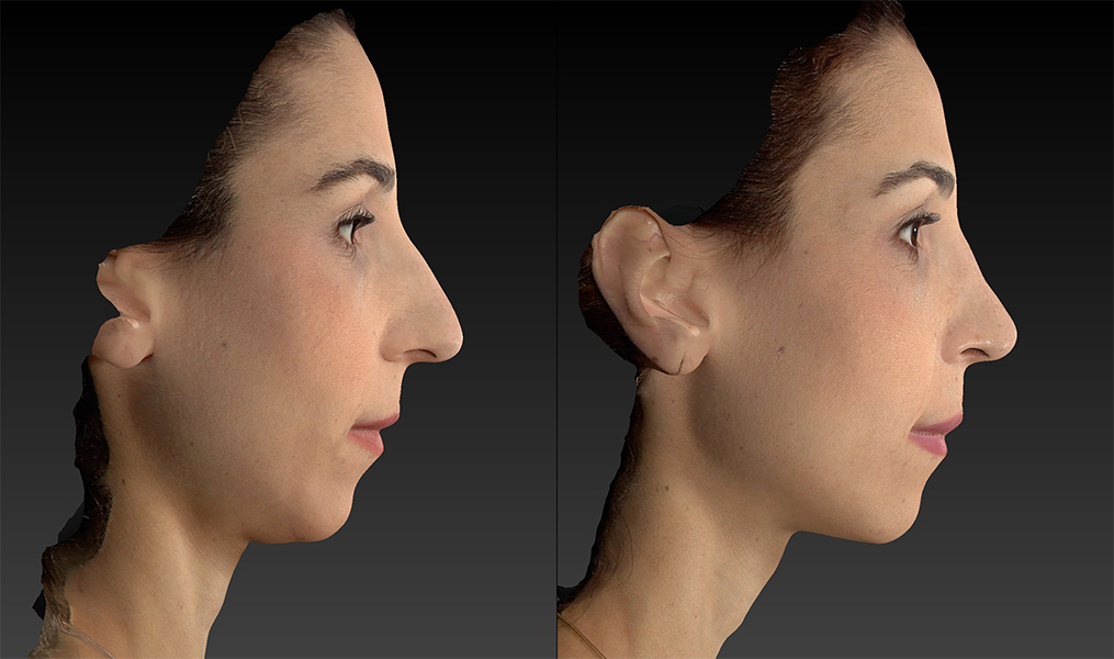 before and after rhinoplasty right side view case 3664