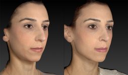 before and after rhinoplasty right angle view case 3664