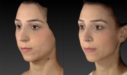 before and after rhinoplasty left angle view case 3664