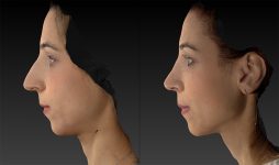 before and after rhinoplasty left side view case 3664