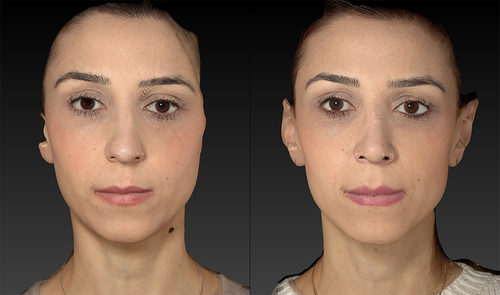before and after rhinoplasty front view case 3664