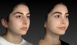 before and after rhinoplasty female patient right angle view case 3415