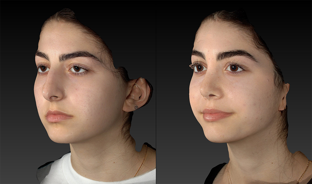 before and after rhinoplasty female patient left angle view case 3415