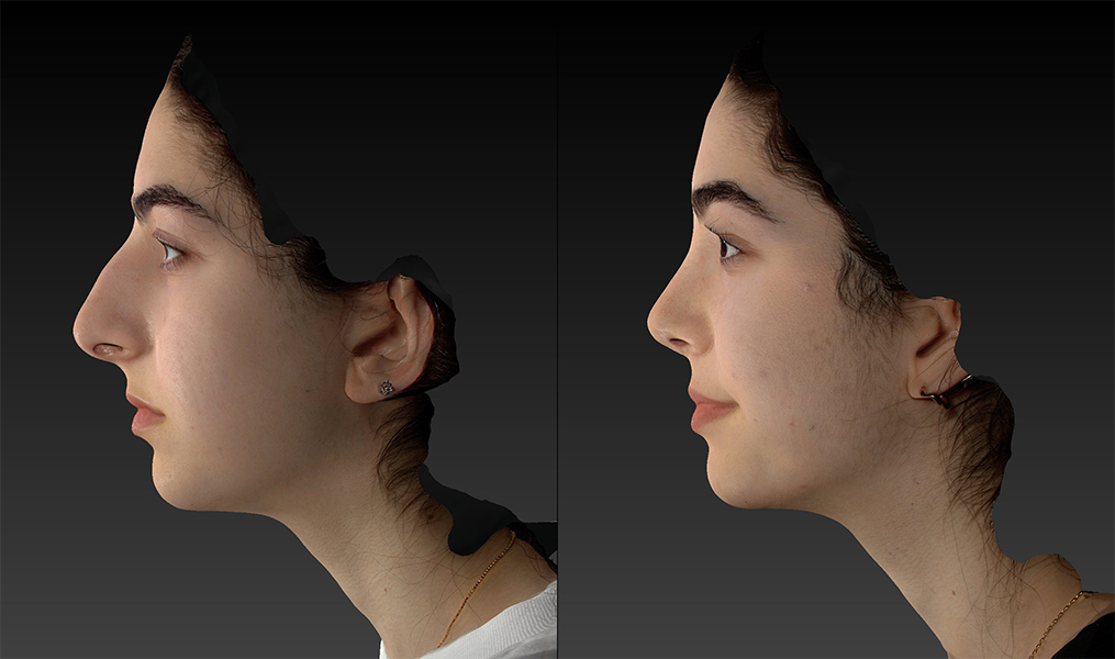 before and after rhinoplasty female patient left side view case 3415