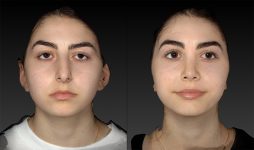 before and after rhinoplasty female patient front view case 3415