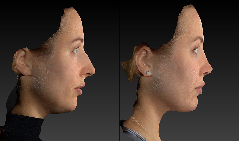 before and after rhinoplasty female patient right side view case 3423