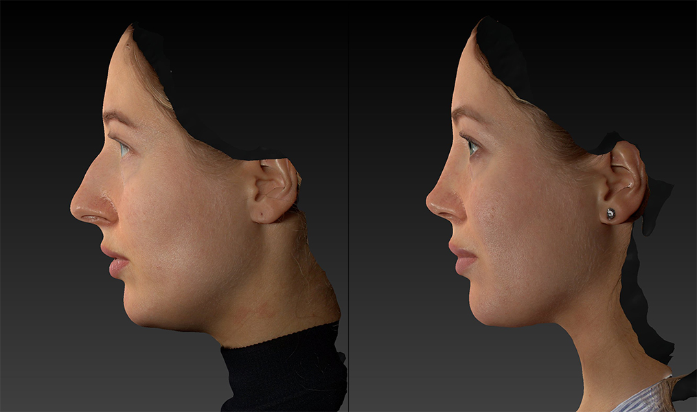 before and after rhinoplasty female patient left side view case 3423