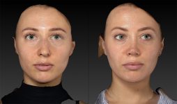 before and after rhinoplasty female patient front view case 3423