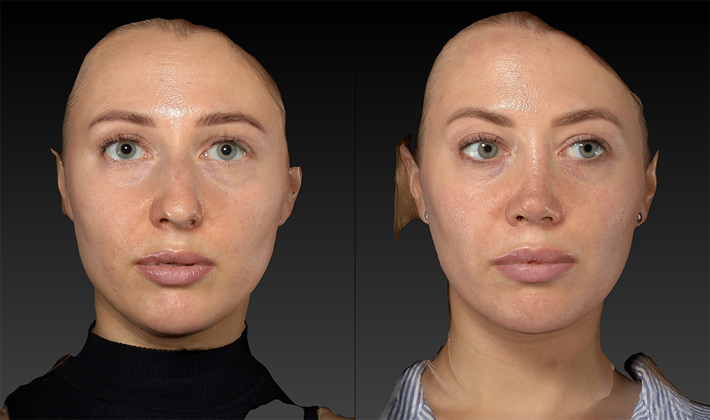 before and after rhinoplasty female patient front view case 3423