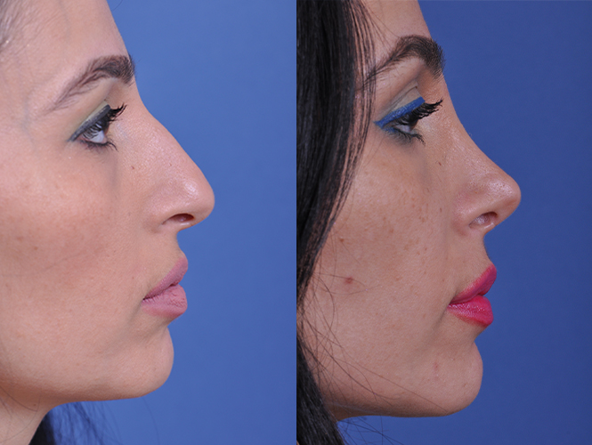 Rhinoplasty before and after, profile view