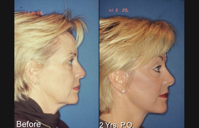 before and after neck liposuction right side view female patient case 3490