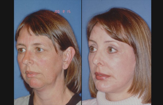 before and after neck liposuction left angle view female patient case 1995