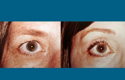 before and after neck liposuction eye view female patient case 1995
