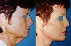 before and after neck liposuction right view female patient case 3519