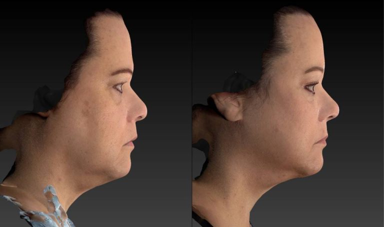 Before and After Submental Neck Liposuction Female Patient Right Side View Case 3568