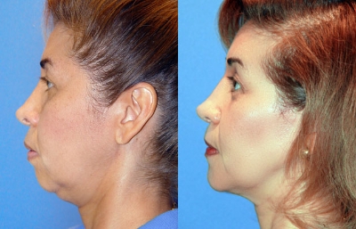 before and after neck liposuction left side view female patient case 3476