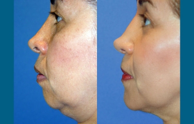 before and after neck liposuction left side view female patient case 3476