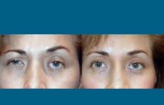 before and after neck liposuction eye view female patient case 3476
