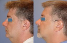 before and after neck liposuction left side view male patient case 3500