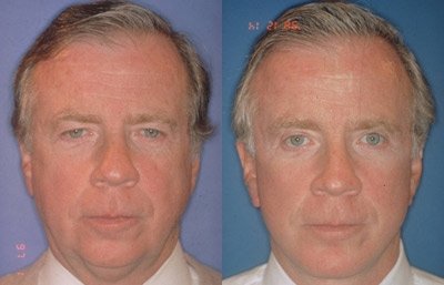 before and after neck liposuction front view male patient case 1986