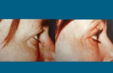 before and after neck liposuction right side eye view female patient case 1995