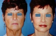 before and after neck liposuction front view female patient case 3519