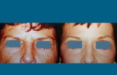 before and after neck liposuction close front view female patient case 3519