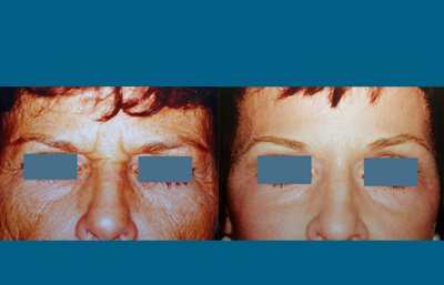 before and after neck liposuction close front view female patient case 3519
