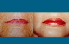 before and after neck liposuction mouth view female patient case 3519