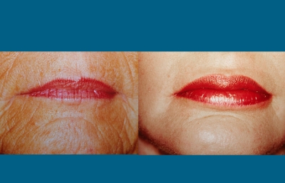 before and after neck liposuction mouth view female patient case 3519