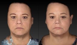 Before and After Submental Neck Liposuction Female Patient Front Angle View Case 3568