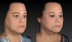 Before and After Submental Neck Liposuction Female Patient Right Angled View Case 3568