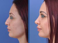 before and after vampire facelift and injectables left side view case 3233
