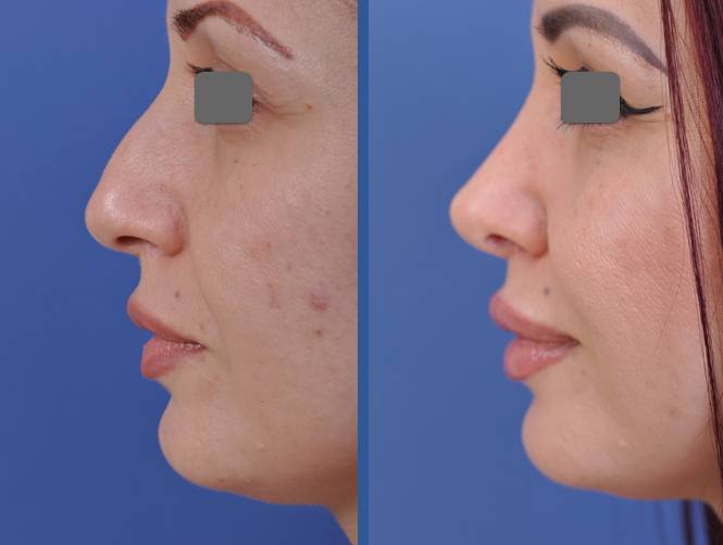 before and after vampire facelift and injectables left side view case 3233