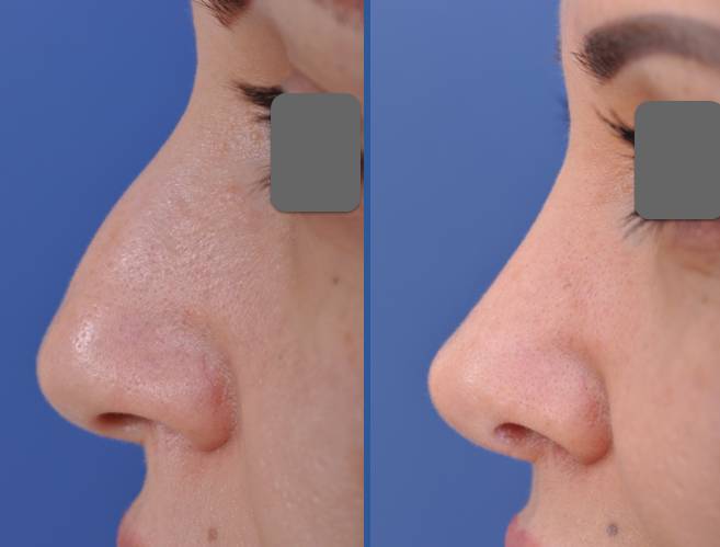 before and after vampire facelift and injectables case left side view case 3233