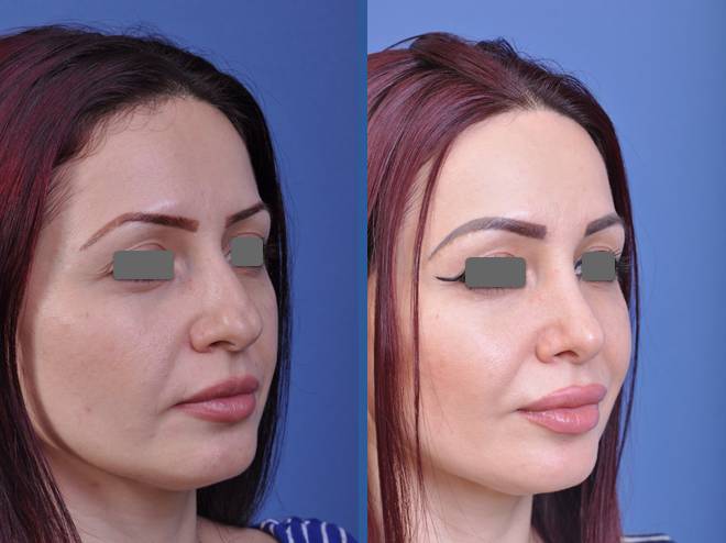 before and after vampire facelift and injectables right angle view case 3233